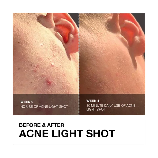 Cult FaceGym Acne Light Shot Device