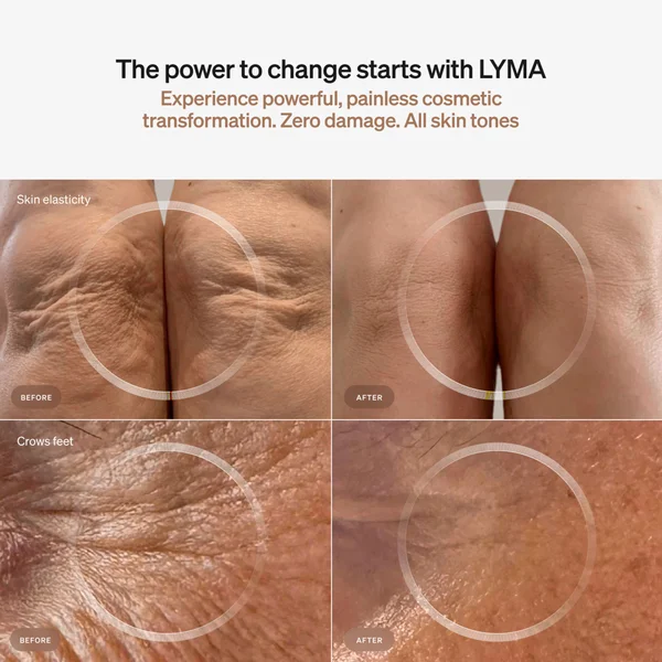 Cult LYMA Laser Starter Kit