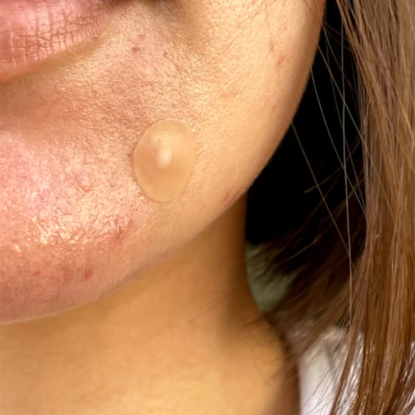 Cult Peace Out Jumbo Acne Dots (40 Dots)