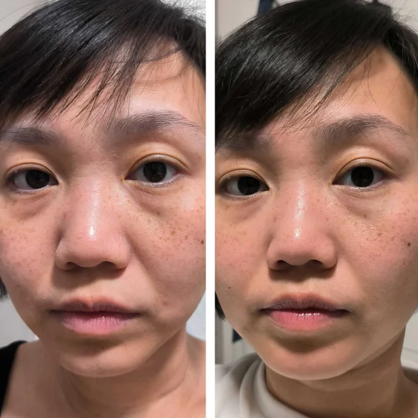 Cult Qure Micro-Infusion Targeted Patches (8 Pairs)