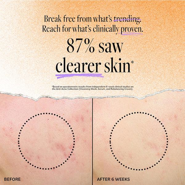 Derma E Acne Deep Pore Cleansing Wash