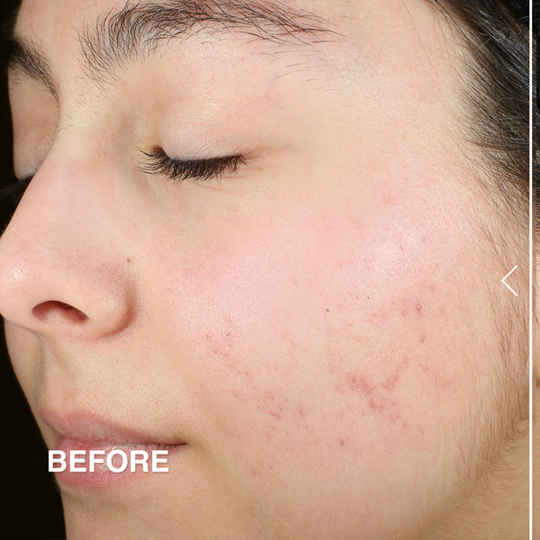 Derma E Sulfur Spot Treatment