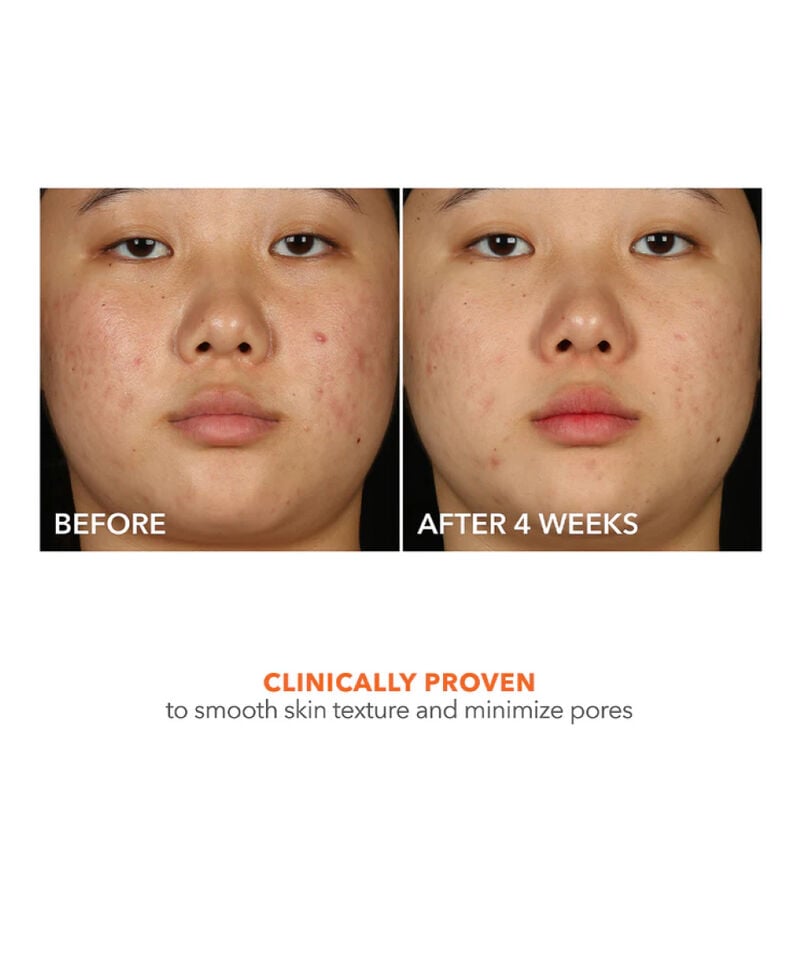 Dr Dennis Gross Alpha Beta® 2% BHA+ Breakout Solution