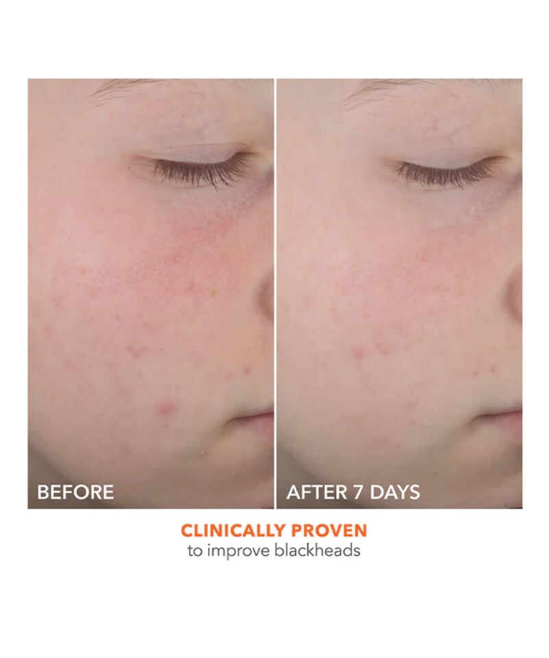 Dr Dennis Gross Alpha Beta® On The Spot Eliminator 2% Salicylic Acid Acne Treatment Gel