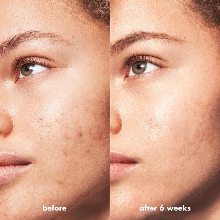 E.l.f. Cosmetics Blemish Breakthrough Acne Fighting Spot Gel