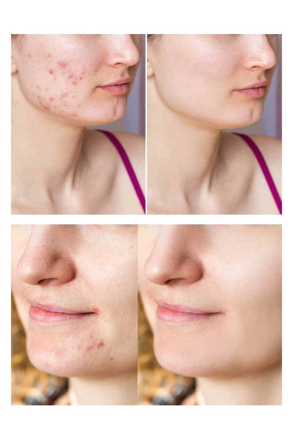 Elo RetinoVita Anti Acne Serum