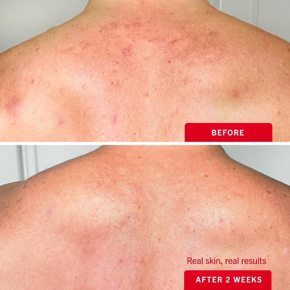 First Aid Beauty Body Acne Clearing Mist 2% Salicylic Acid Treatment