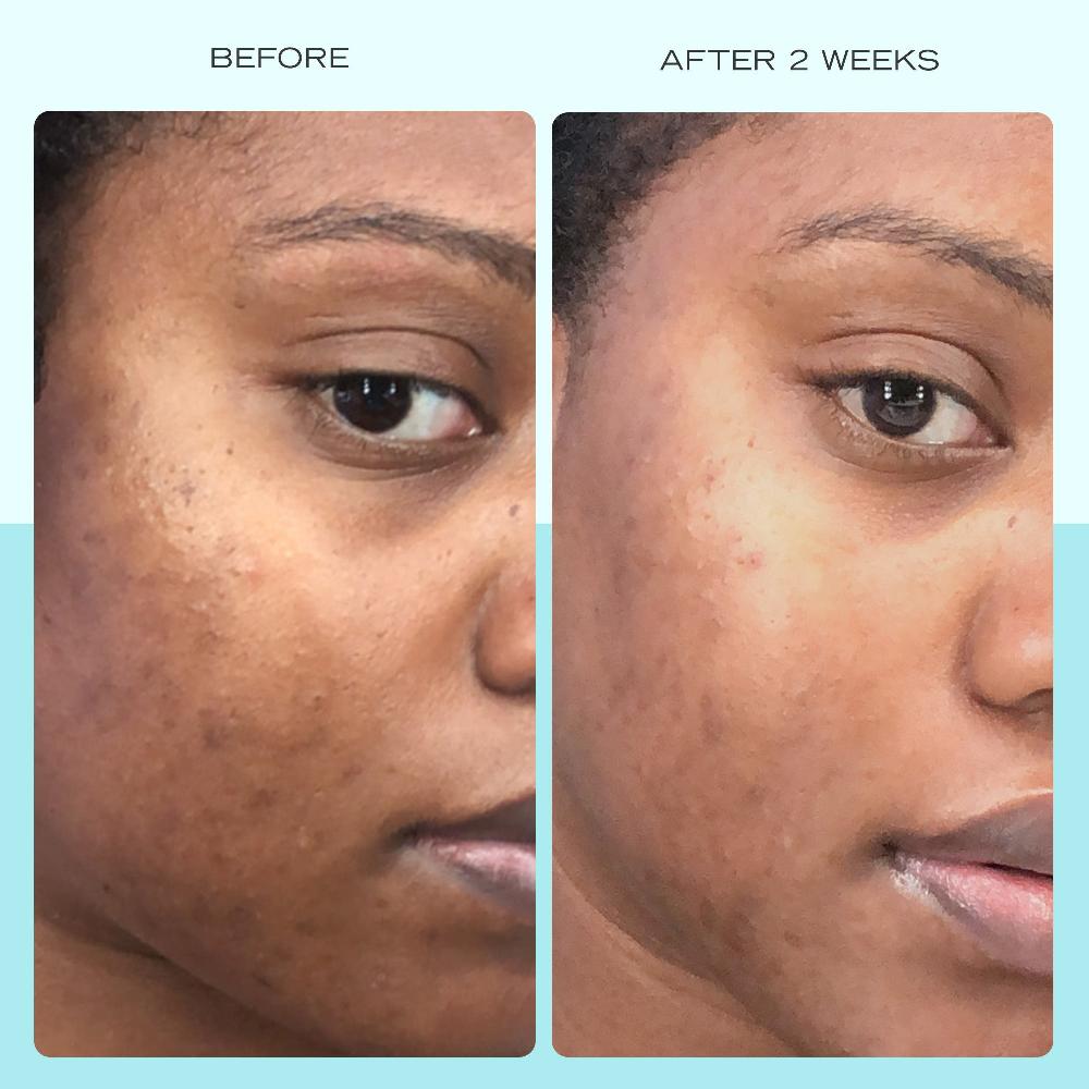First Aid Beauty Dark Spot Serum With Niacinamide Serum