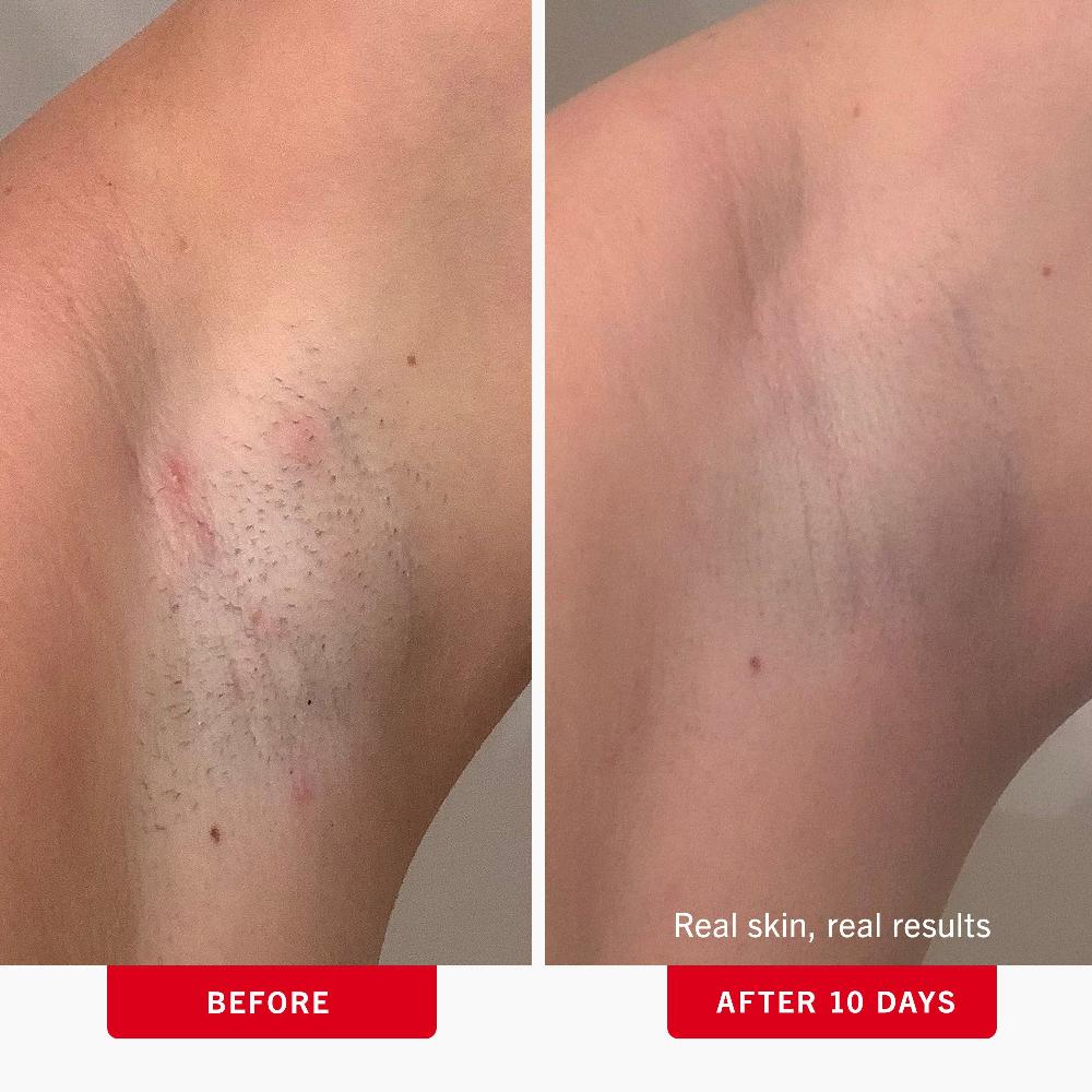 First Aid Beauty Ingrown Hair Pads With BHA + AHA Exfoliator