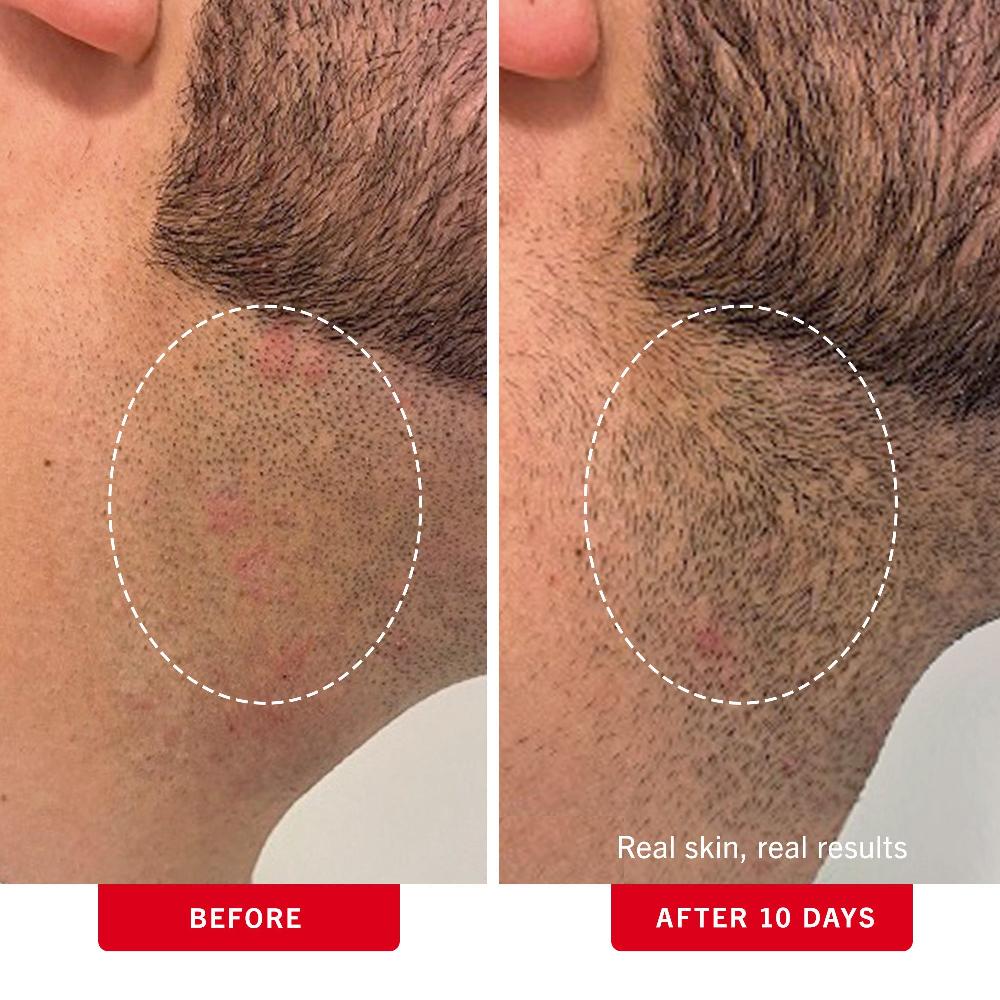 First Aid Beauty Ingrown Hair Pads With BHA + AHA Exfoliator