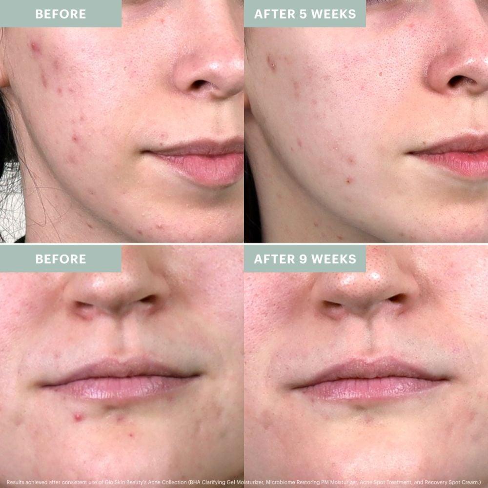 Glo Minerals Acne Collection Bundle