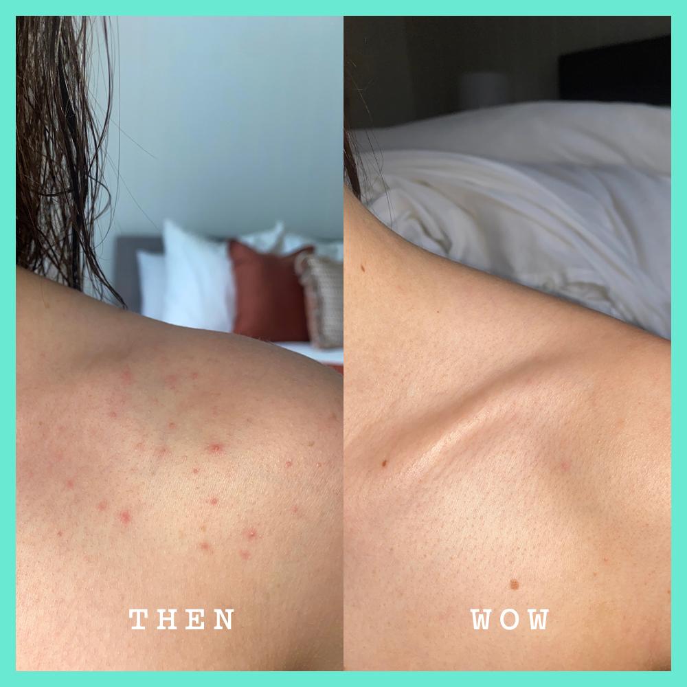 Frank Body Acid Heroes Kit