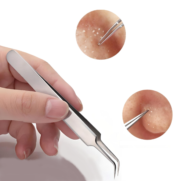 glamza Blackhead Removal Tweezers - Straight – Professional Precision for Clearer Skin & FREE POSTAGE