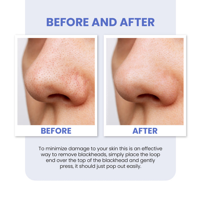 Glamza 7pc Blackhead Pimple Tool Kit