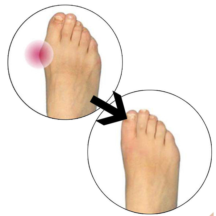 Glamza Glamza Splint Corrector Device Pair