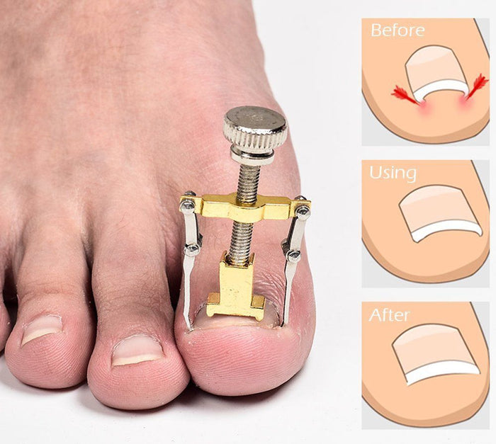 Glamza Ingrown Toenail Corrector Clamp