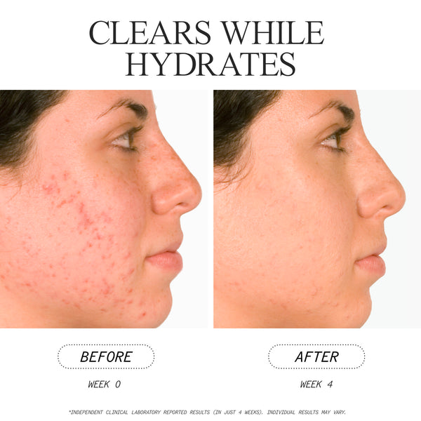 Juice Beauty Salicylic Acid Acne Serum