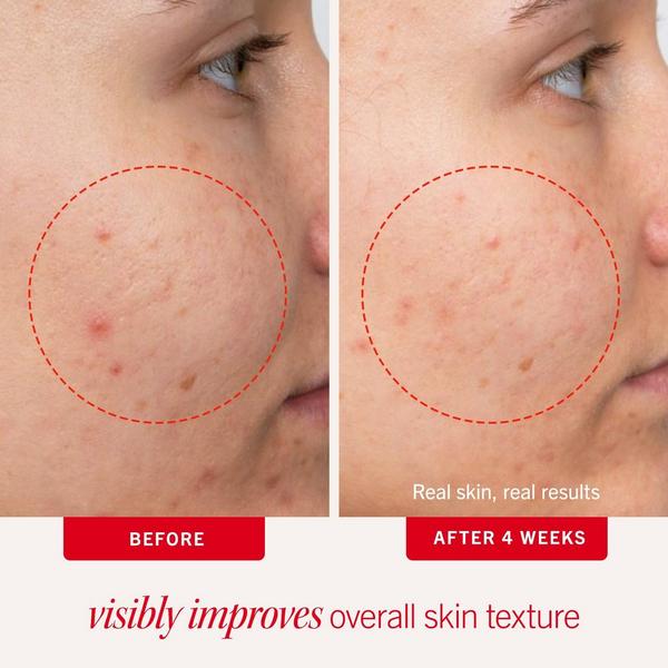 Ulta First Aid Beauty  Acne Clearing Pads 2% Salicylic Acid Acne Treatment