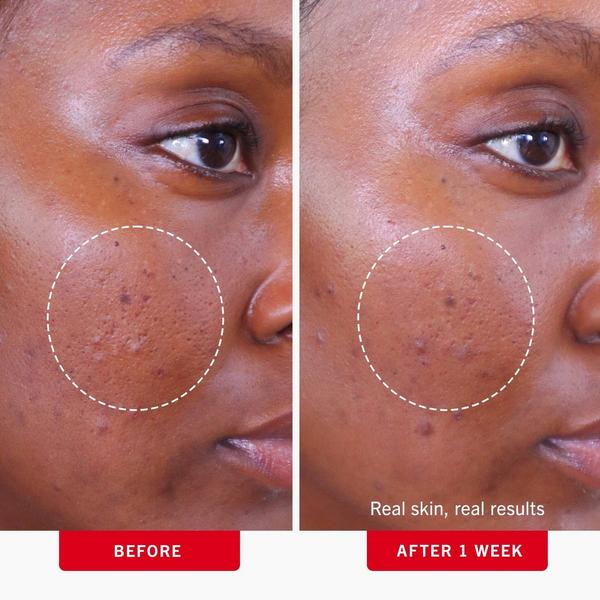Ulta First Aid Beauty  Acne Clearing Pads 2% Salicylic Acid Acne Treatment