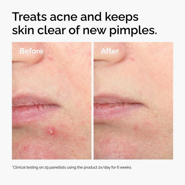 Ulta The Ordinary  Salicylic Acid 2% Solution Exfoliating Serum For Acne