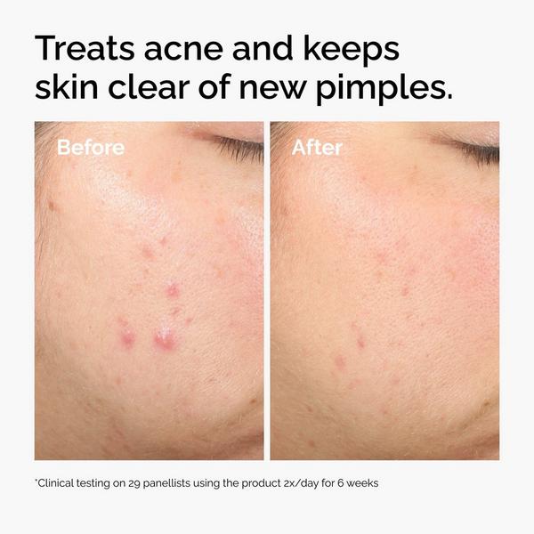 Ulta The Ordinary  Salicylic Acid 2% Solution Exfoliating Serum For Acne