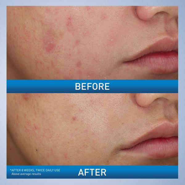 Ulta CeraVe  Acne Foaming Cream Wash