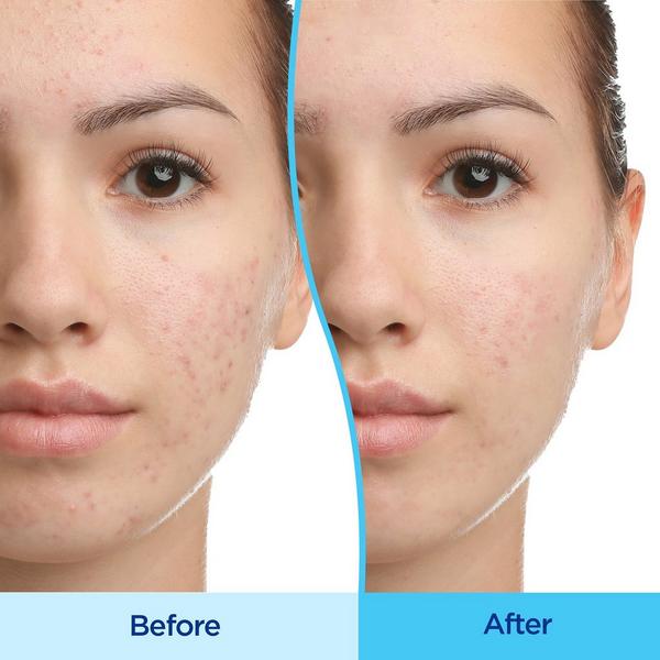Ulta Differin  Adapalene 0.1% Acne Treatment Gel