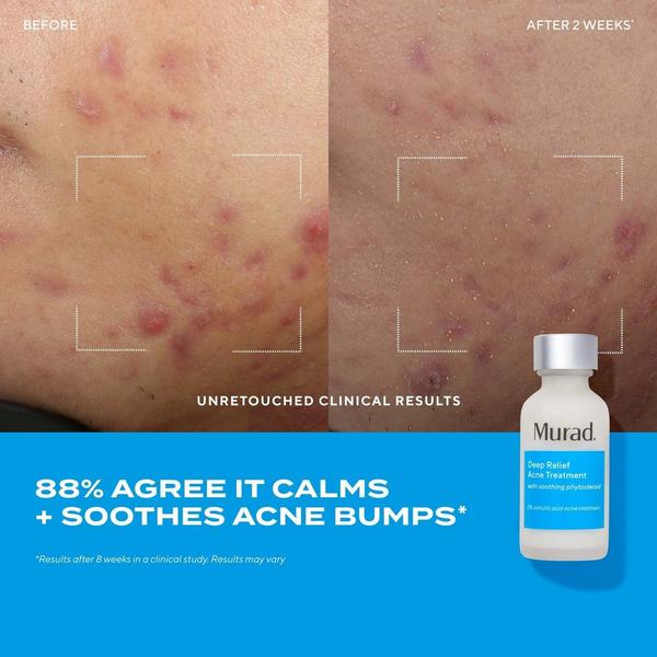 Ulta Murad  Deep Relief Acne Treatment