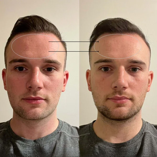 BEAUTYPRO LED Mask Device