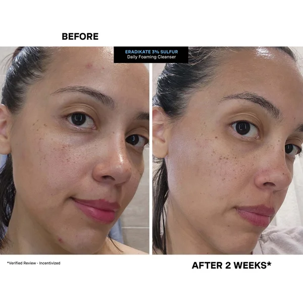 Kate Somerville Blemish Punisher Exclusive Kit