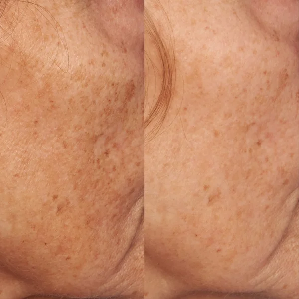 Perricone MD VCE Intensive Dark Spot Treatment
