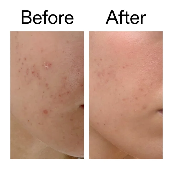 The INKEY List Mandelic Acid Treatment 15ml