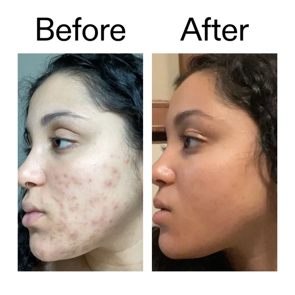 The INKEY List Tranexamic Acid Serum 30ml