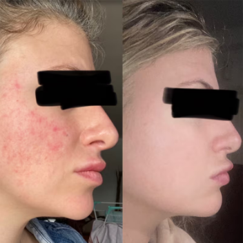 Natural Elements Natural Rosacea Skincare