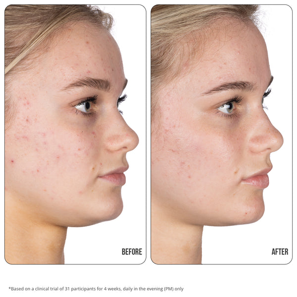 Nip Fab Retinol Fix Blemish Gel Treatment 10% 15ml