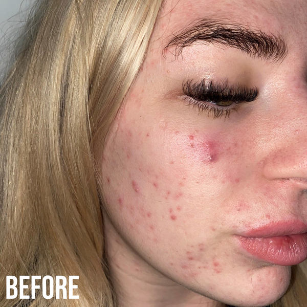 Nip Fab The Anti-blemish Duo