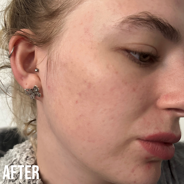 Nip Fab The Anti-blemish Duo