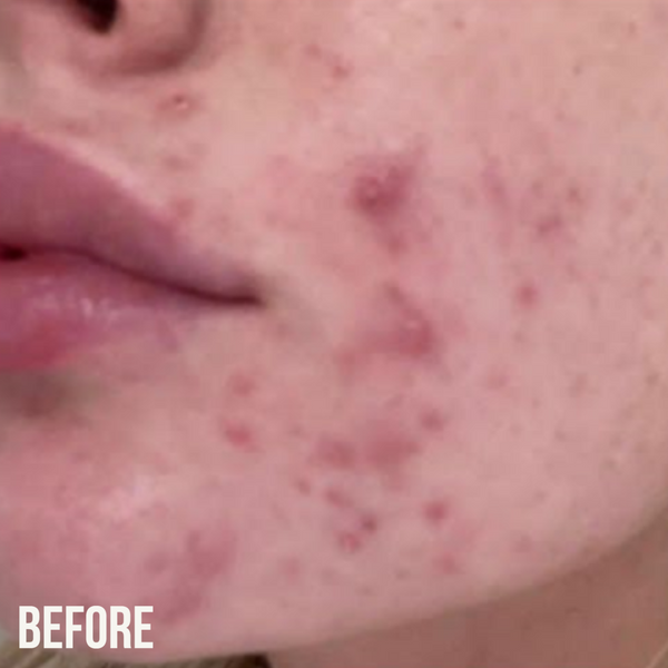 Nip Fab Salicylic Acid Fix Oil Control Routine Kit For Acne & Blemish Prone Skin