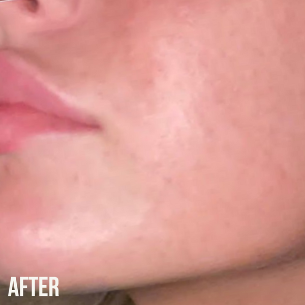 Nip Fab Salicylic Acid Fix Oil Control Routine Kit For Acne & Blemish Prone Skin