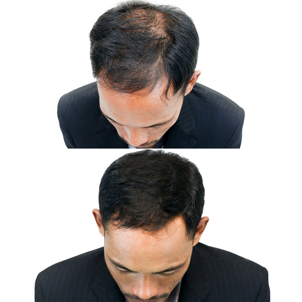 Pacinos Minoxidil 5% - 6 MONTH SUPPLY BUNDLE