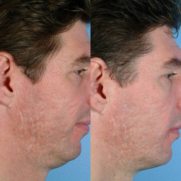 Pmd Beauty Personal Microderm Man - Microdermabrasion For Men