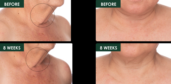 Révive Fermitif Neck Renewal Serum / Firming Treatment