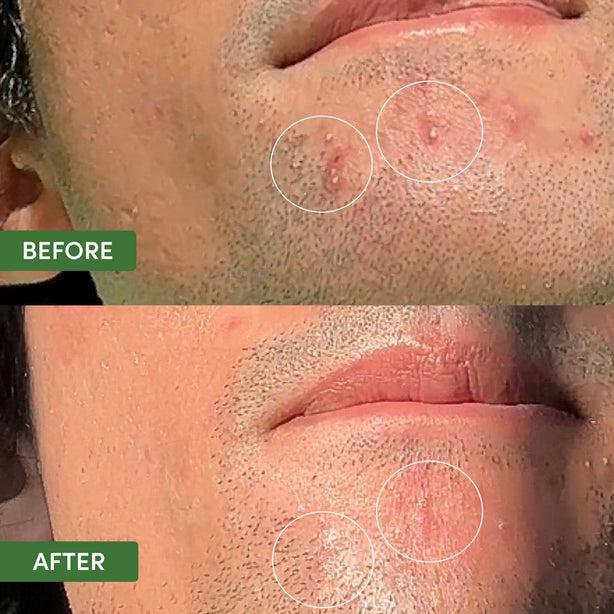 Sand & Sky Oil Control Dual Action Blemish Patches