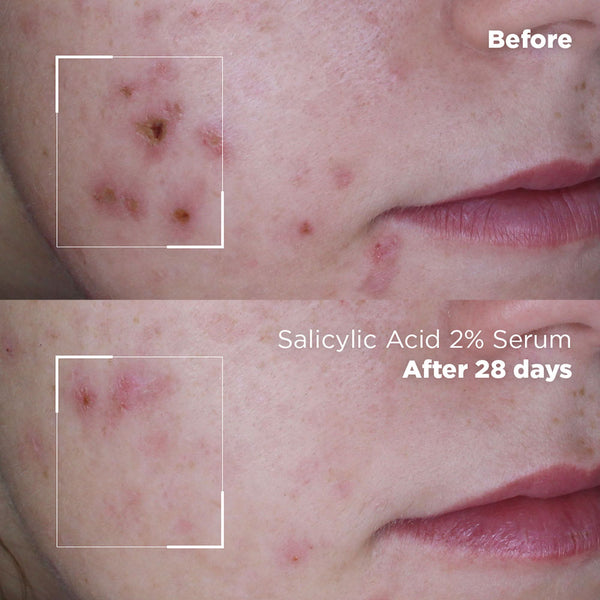 Skin Republic Salicylic Acid 2% Serum - Skin Republic - South Africa - Skin Republic South Africa