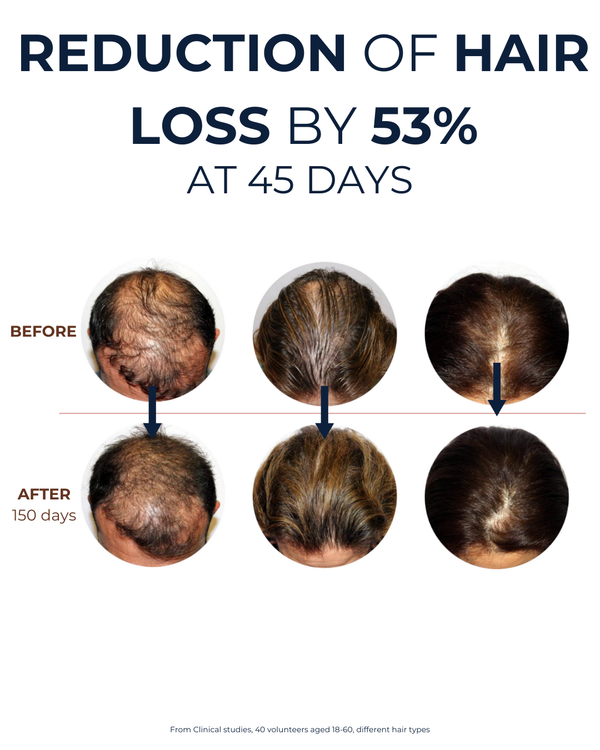 Standard 5-Months-Supply | Peptide Hair Growth Serum With Rosemary Extract & Plant-Stem-Cells