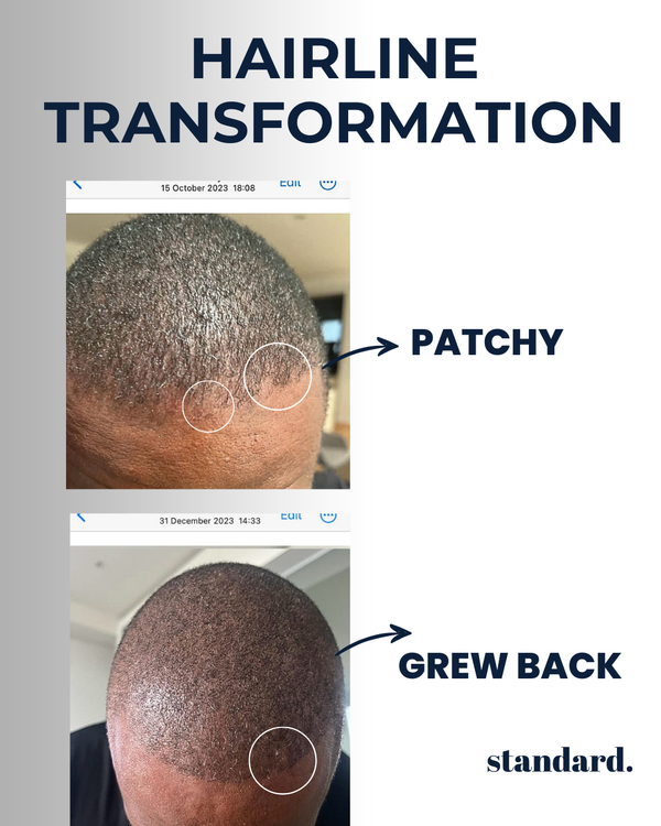 Standard 5-Months-Supply | Peptide Hair Growth Serum With Rosemary Extract & Plant-Stem-Cells