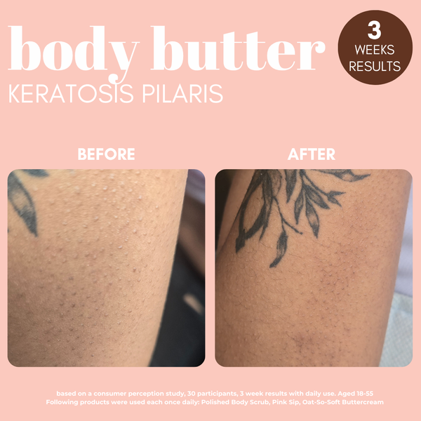 Standard Oat-So-Soft Buttercream With Oat Extract & 1% Salicylic Acid